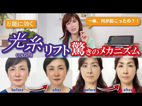 【最先端美容光糸リフト】メカニズムを徹底解説 20分でここまで変わる美容整形超えの大変身！